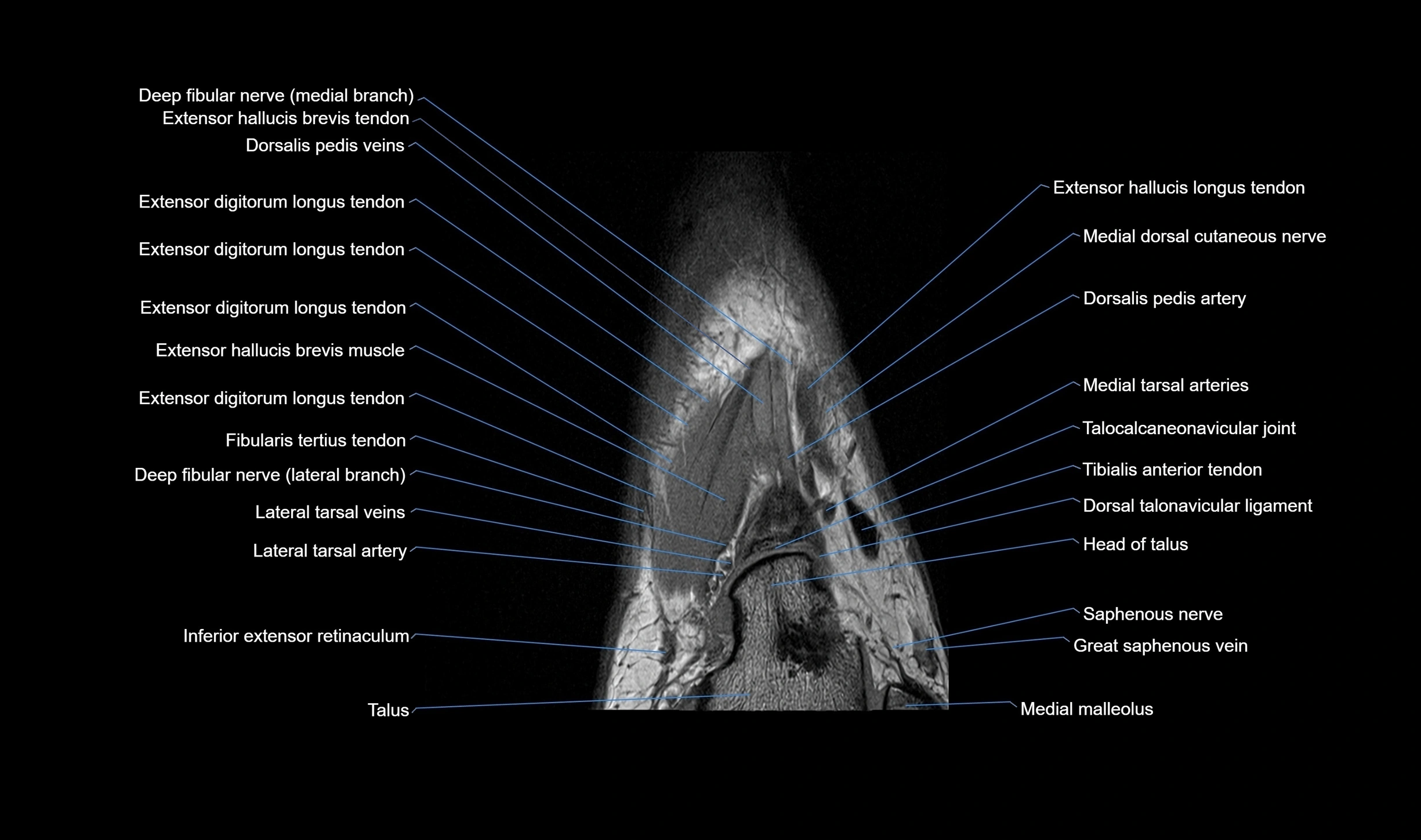 MRI mid foot coronal ligaments cross sectional anatomy 3T  radiology  image-img-00001-00011.webp